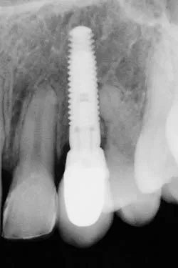 implant1