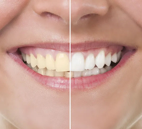 whitening1